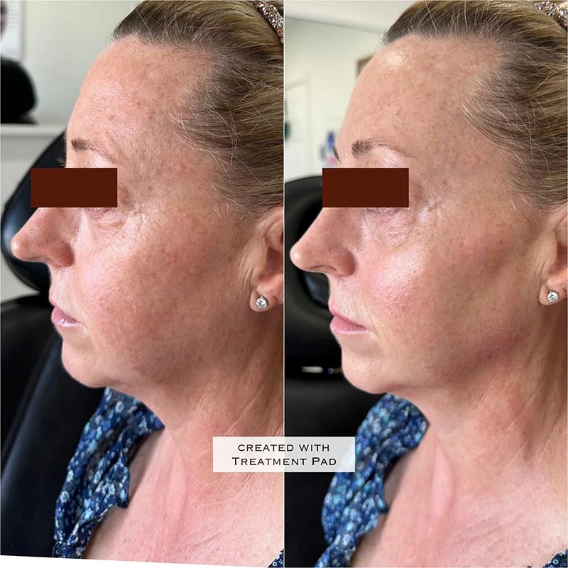 Facial Volume Loss-after-A-Pretty-Please-Aesthetics-in-roseville-ca