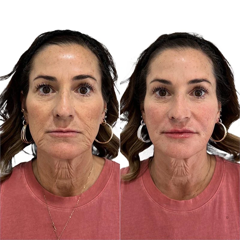 Facial Volume Loss-after-B-Pretty-Please-Aesthetics-in-roseville-ca