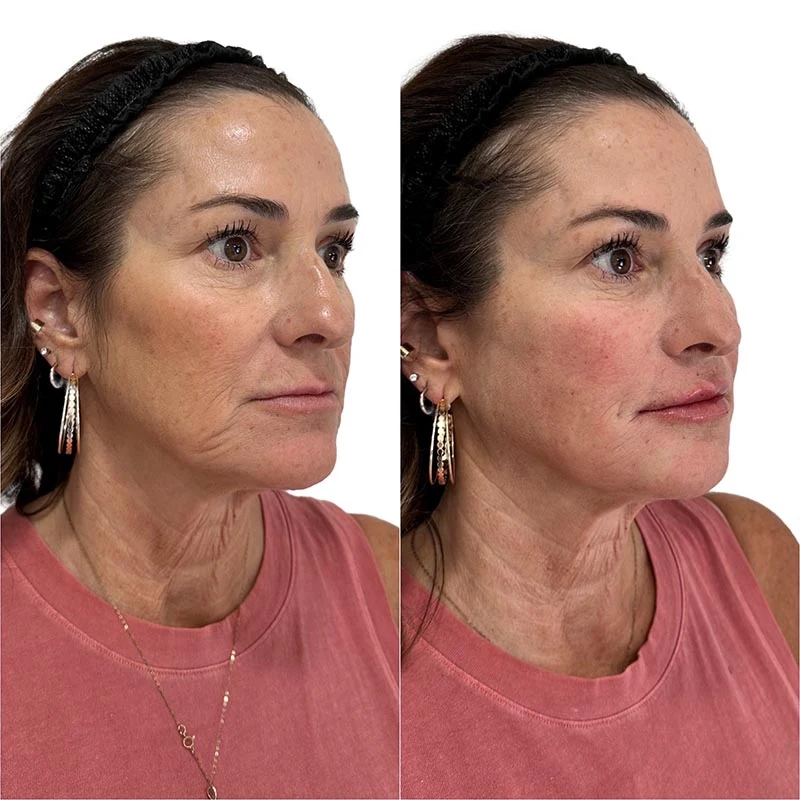 Facial Volume Loss-after-C-Pretty-Please-Aesthetics-in-roseville-ca