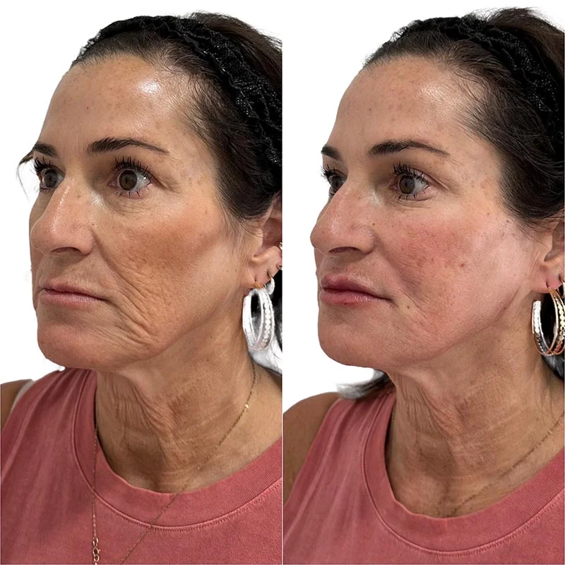 Facial Volume Loss-after-D-Pretty-Please-Aesthetics-in-roseville-ca
