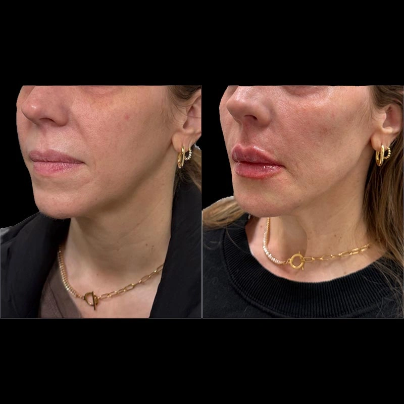 Facial Volume Loss-after-E-Pretty-Please-Aesthetics-in-roseville-ca