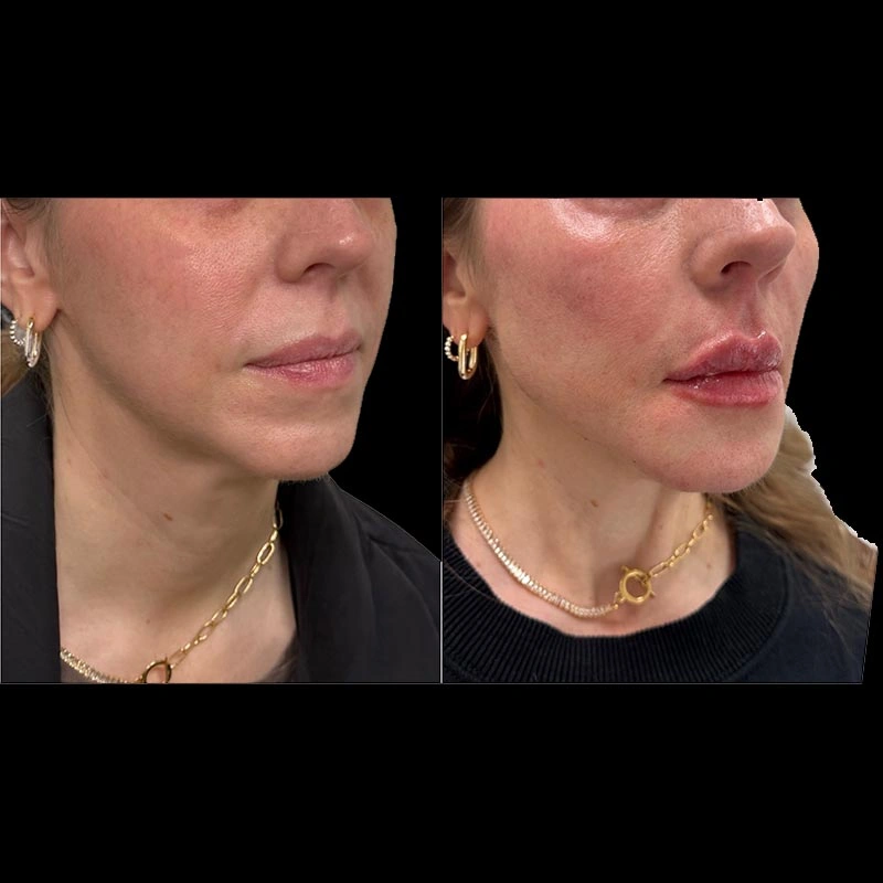 Facial Volume Loss-after-F-Pretty-Please-Aesthetics-in-roseville-ca