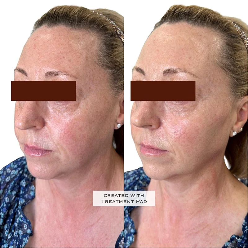 Facial Volume Loss-after-Pretty-Please-Aesthetics-in-roseville-ca