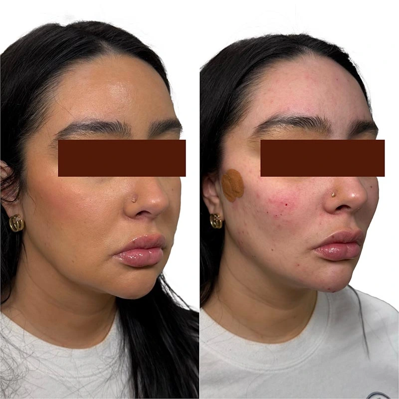 Facial Volume Loss-after-before-A-Pretty-Please-Aesthetics-in-roseville-ca