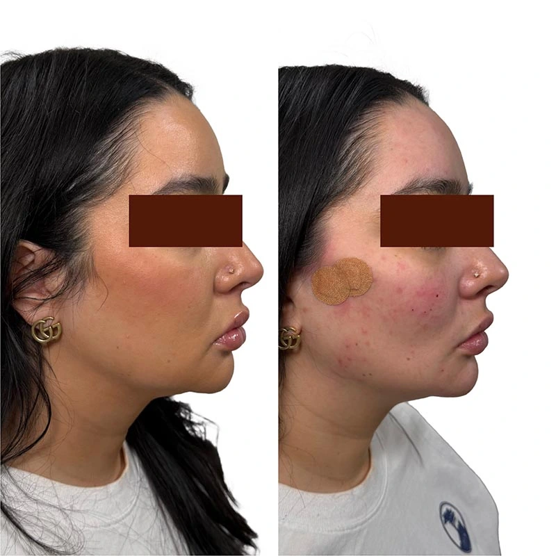 Facial Volume Loss-after-before-B-Pretty-Please-Aesthetics-in-roseville-ca