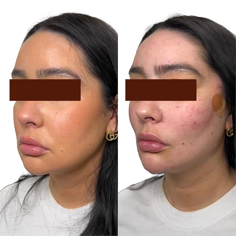 Facial Volume Loss-after-before-C-Pretty-Please-Aesthetics-in-roseville-ca