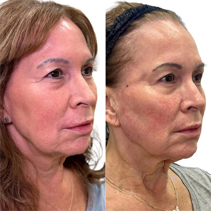 Facial Volume Loss-after-before-D-Pretty-Please-Aesthetics-in-roseville-ca