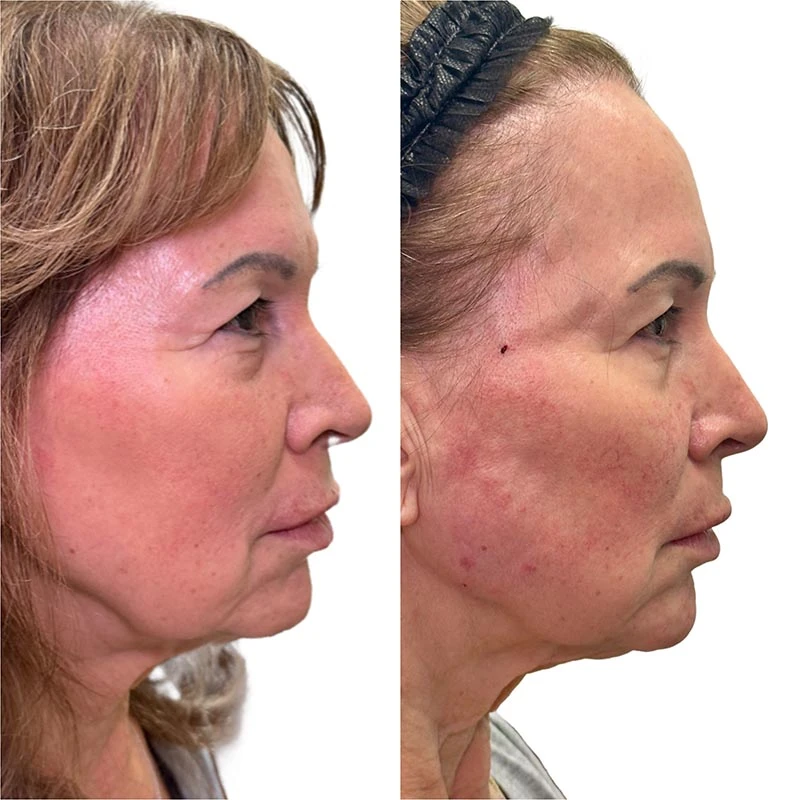 Facial Volume Loss-after-before-E-Pretty-Please-Aesthetics-in-roseville-ca