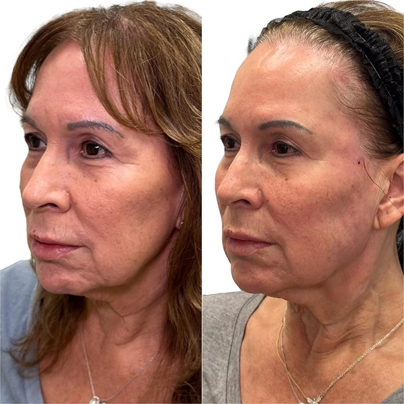 Facial Volume Loss-after-before-F-Pretty-Please-Aesthetics-in-roseville-ca