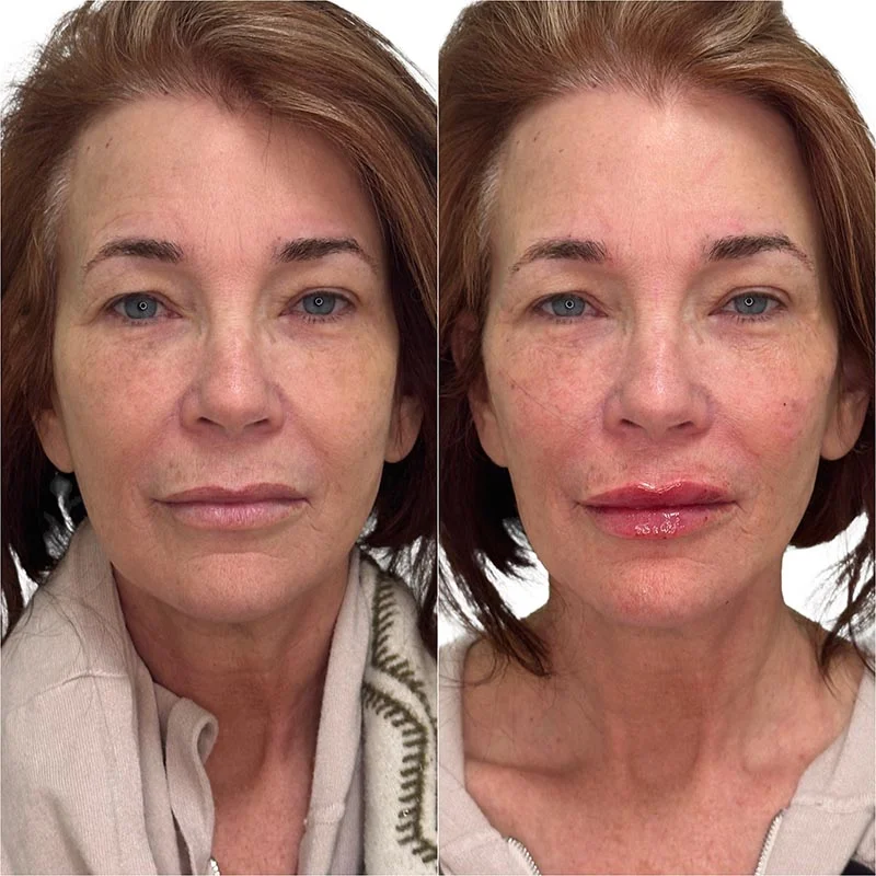 Facial Volume Loss-after-before-G-Pretty-Please-Aesthetics-in-roseville-ca