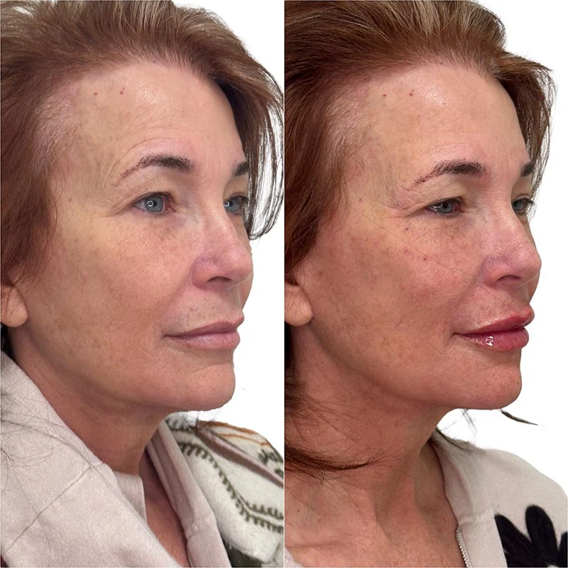 Facial Volume Loss-after-before-H-Pretty-Please-Aesthetics-in-roseville-ca