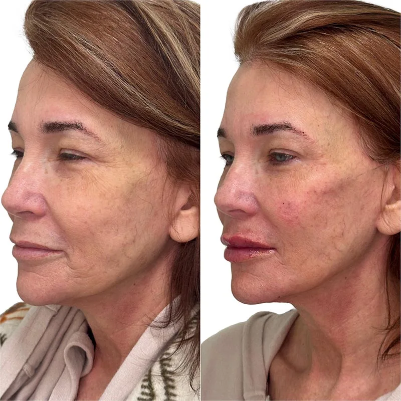 Facial Volume Loss-after-before-I-Pretty-Please-Aesthetics-in-roseville-ca