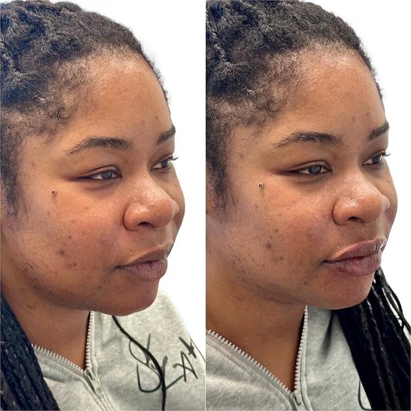 Facial Volume Loss-after-before-J-Pretty-Please-Aesthetics-in-roseville-ca