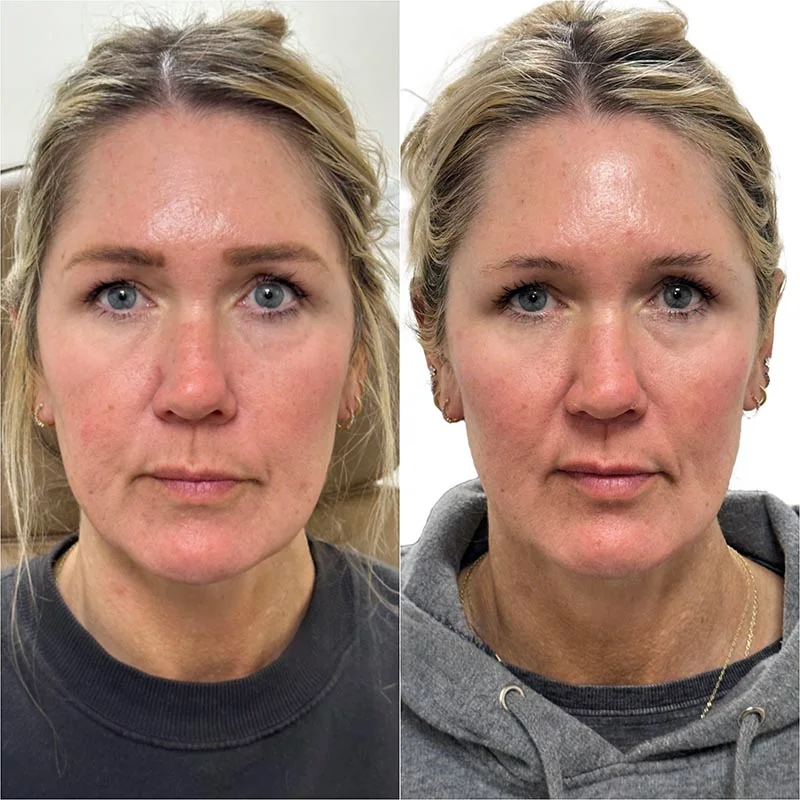 Facial Volume Loss-after-before-K-Pretty-Please-Aesthetics-in-roseville-ca