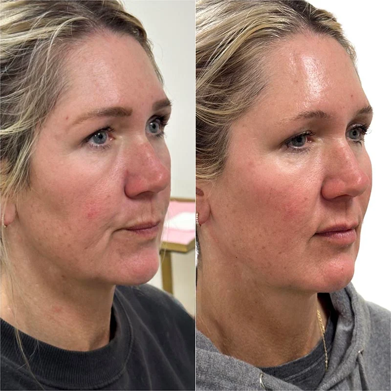 Facial Volume Loss-after-before-L-Pretty-Please-Aesthetics-in-roseville-ca