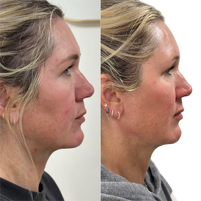 Facial Volume Loss-after-before-M-Pretty-Please-Aesthetics-in-roseville-ca