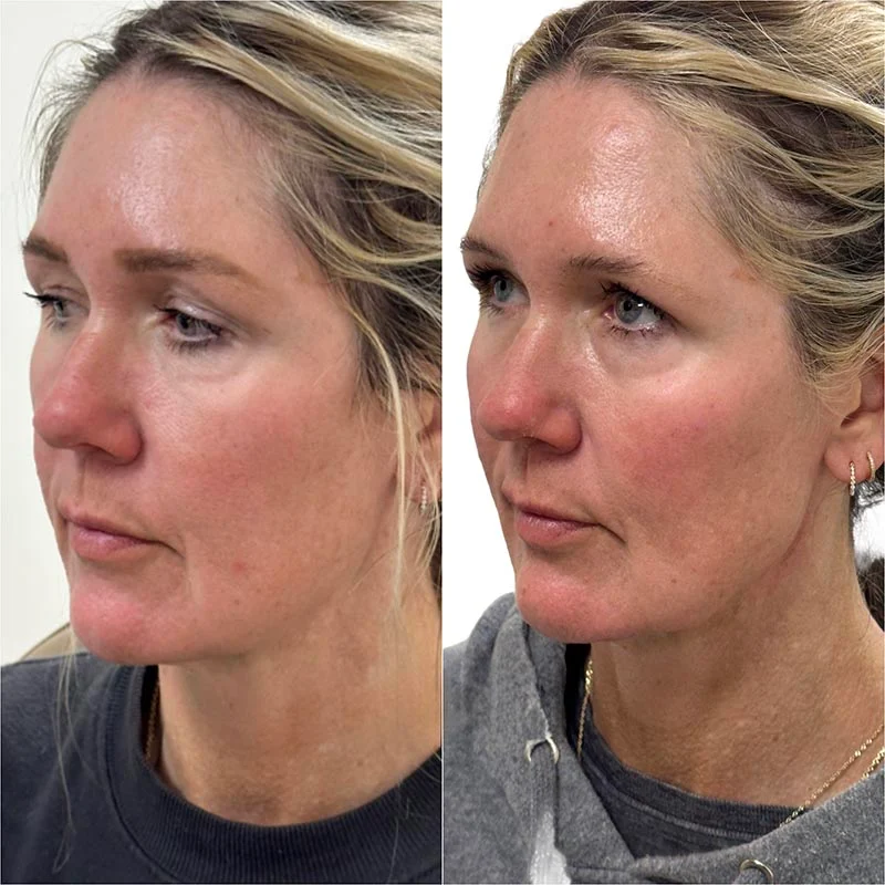 Facial Volume Loss-after-before-N-Pretty-Please-Aesthetics-in-roseville-ca