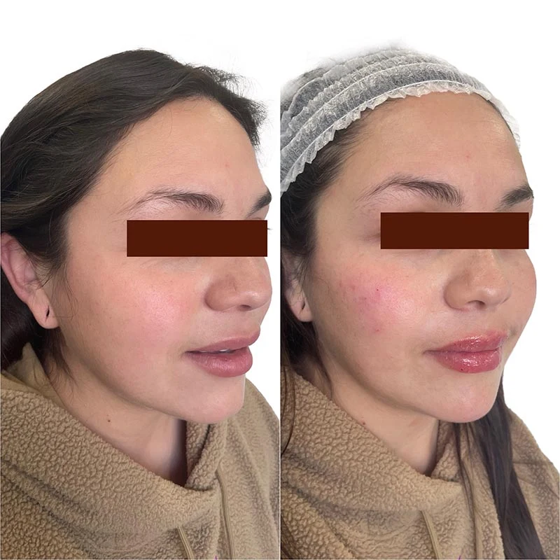 Facial Volume Loss-after-before-O-Pretty-Please-Aesthetics-in-roseville-ca