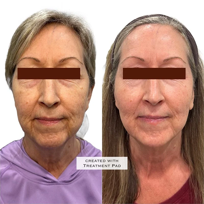 Facial Volume Loss-after-before-P-Pretty-Please-Aesthetics-in-roseville-ca
