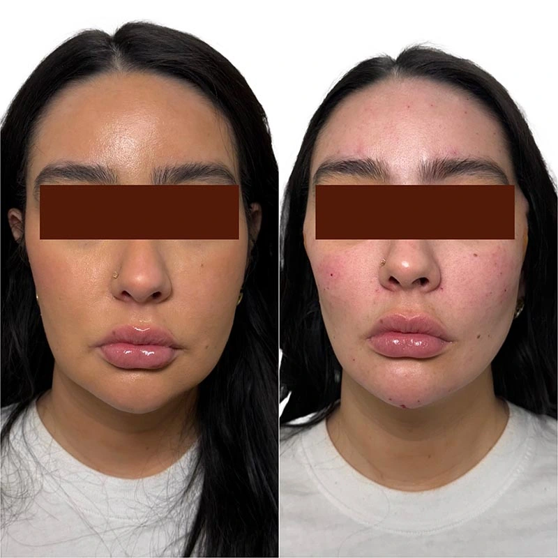 Facial Volume Loss-after-before-Pretty-Please-Aesthetics-in-roseville-ca