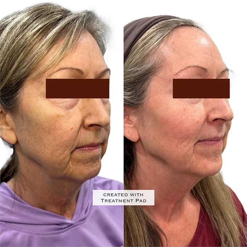 Facial Volume Loss-after-before-Q-Pretty-Please-Aesthetics-in-roseville-ca