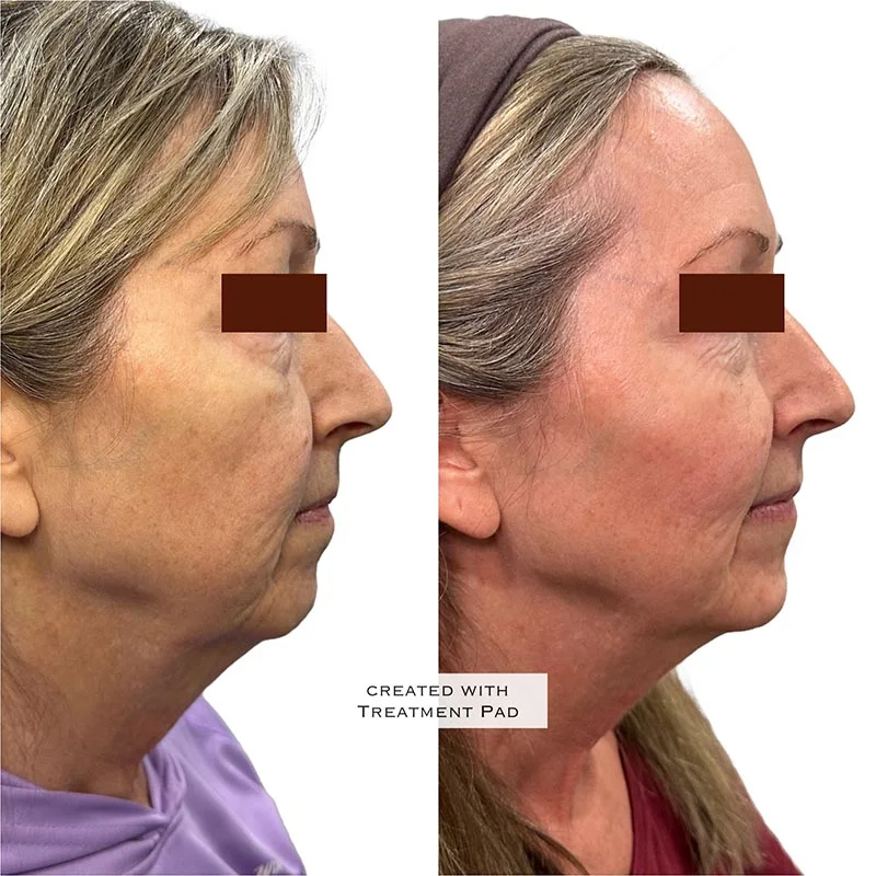 Facial Volume Loss-after-before-R-Pretty-Please-Aesthetics-in-roseville-ca