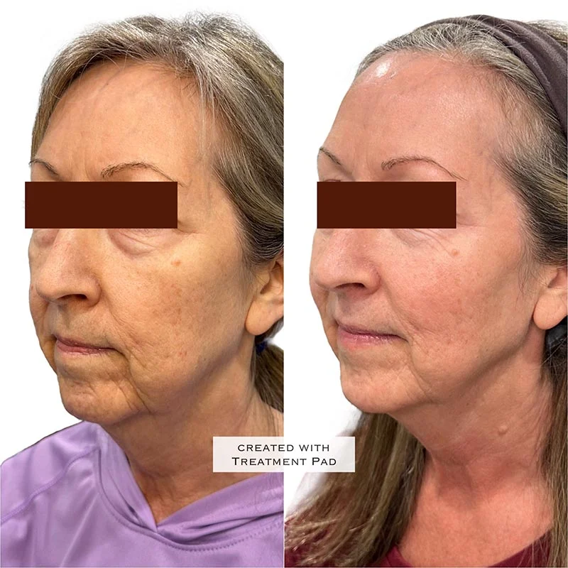 Facial Volume Loss-after-before-S-Pretty-Please-Aesthetics-in-roseville-ca