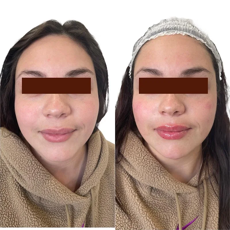 Facial Volume Loss-after-before-T-Pretty-Please-Aesthetics-in-roseville-ca