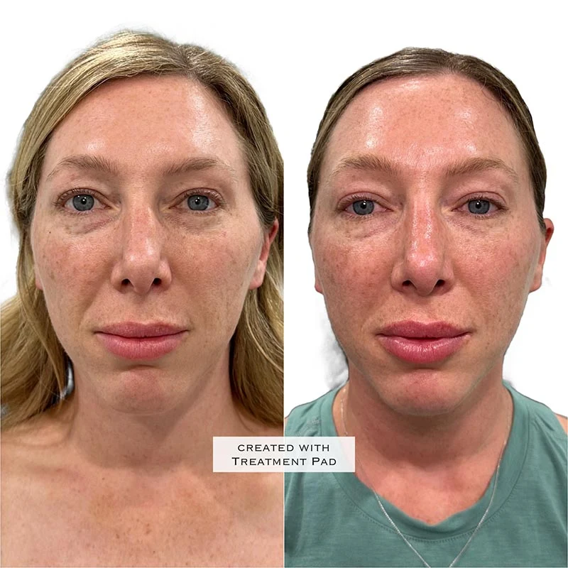 Facial Volume Loss-after-before-U-Pretty-Please-Aesthetics-in-roseville-ca