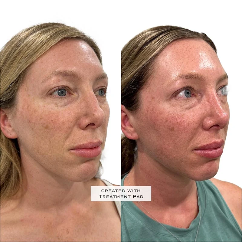 Facial Volume Loss-after-before-V-Pretty-Please-Aesthetics-in-roseville-ca
