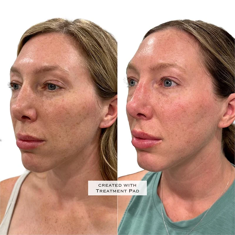 Facial Volume Loss-after-before-X-Pretty-Please-Aesthetics-in-roseville-ca