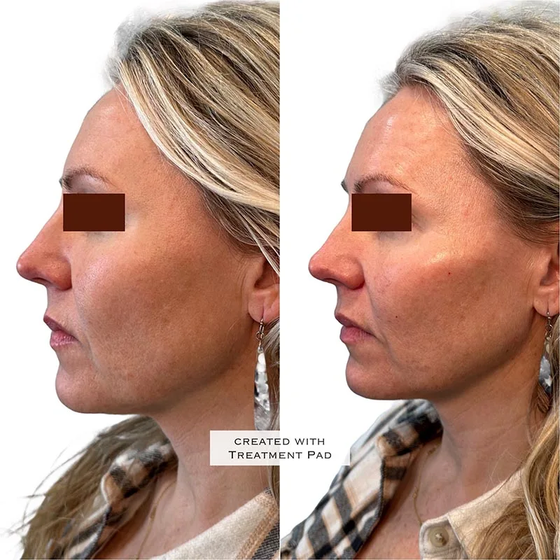 Facial Volume Loss-after-before-Y-Pretty-Please-Aesthetics-in-roseville-ca