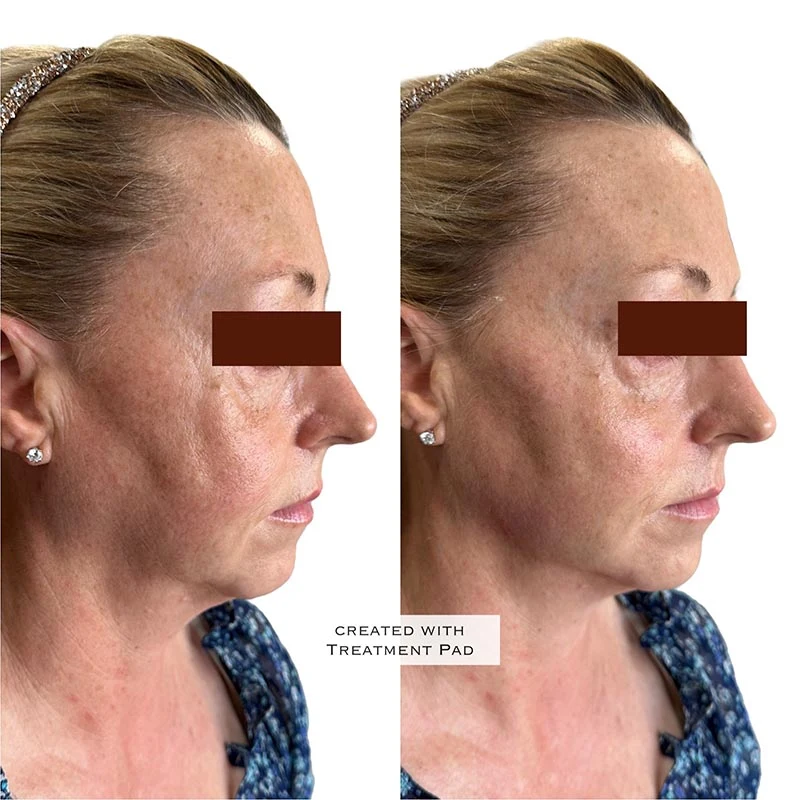 Facial Volume Loss-after-before-Z-Pretty-Please-Aesthetics-in-roseville-ca