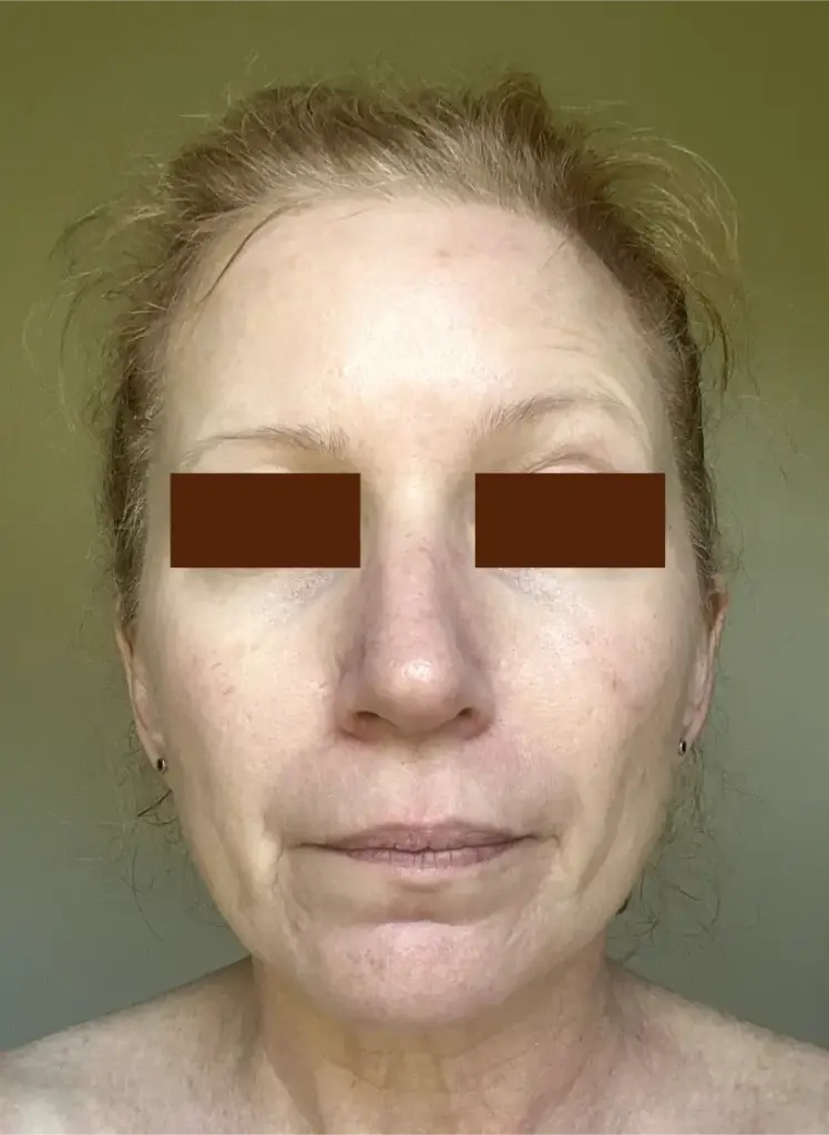 Chemical Peels female face Gallery at pretty please aesthetics